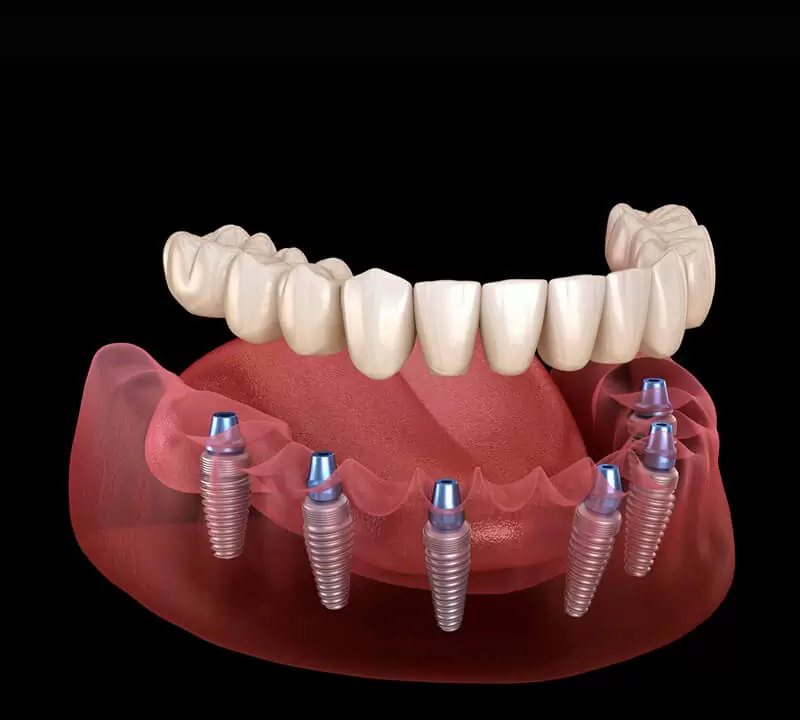 Implantes Múltiplos - Resultado de Implante Dentário