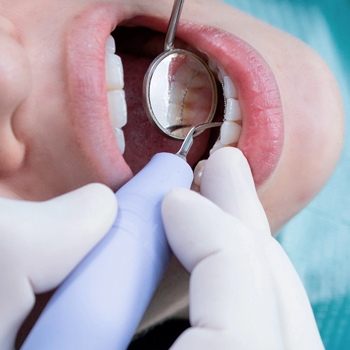 Limpeza Dental Profissional